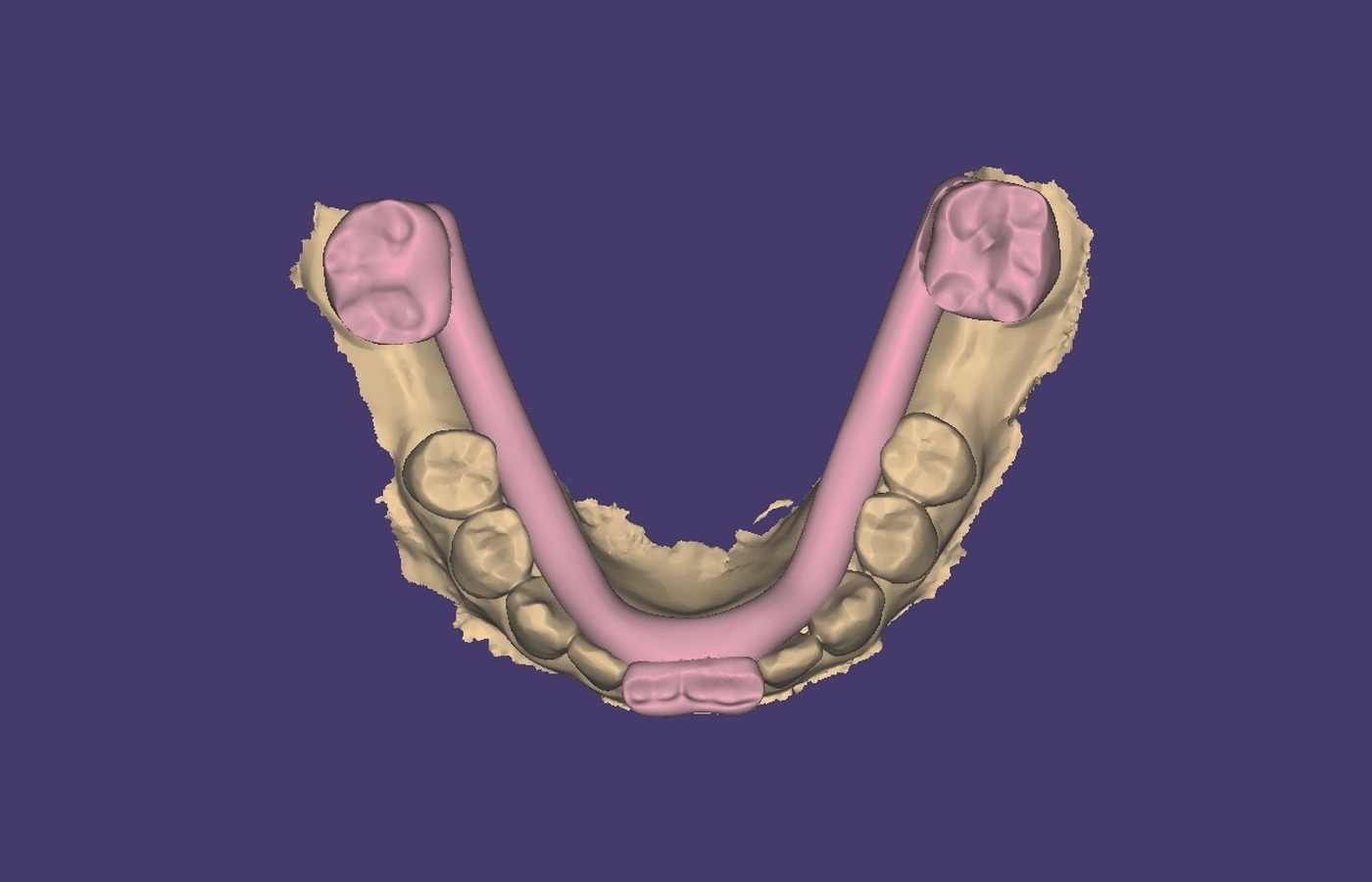 Pink CAD localizator designed over the mandibular arch