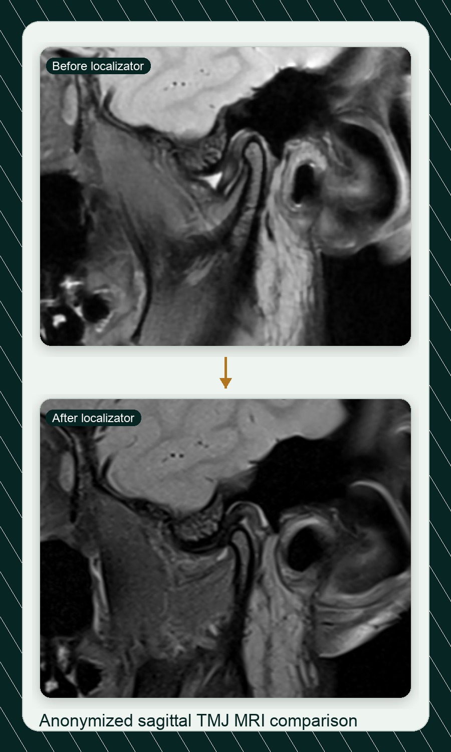 Anonymized before and after TMJ MRI comparison for localizator verification