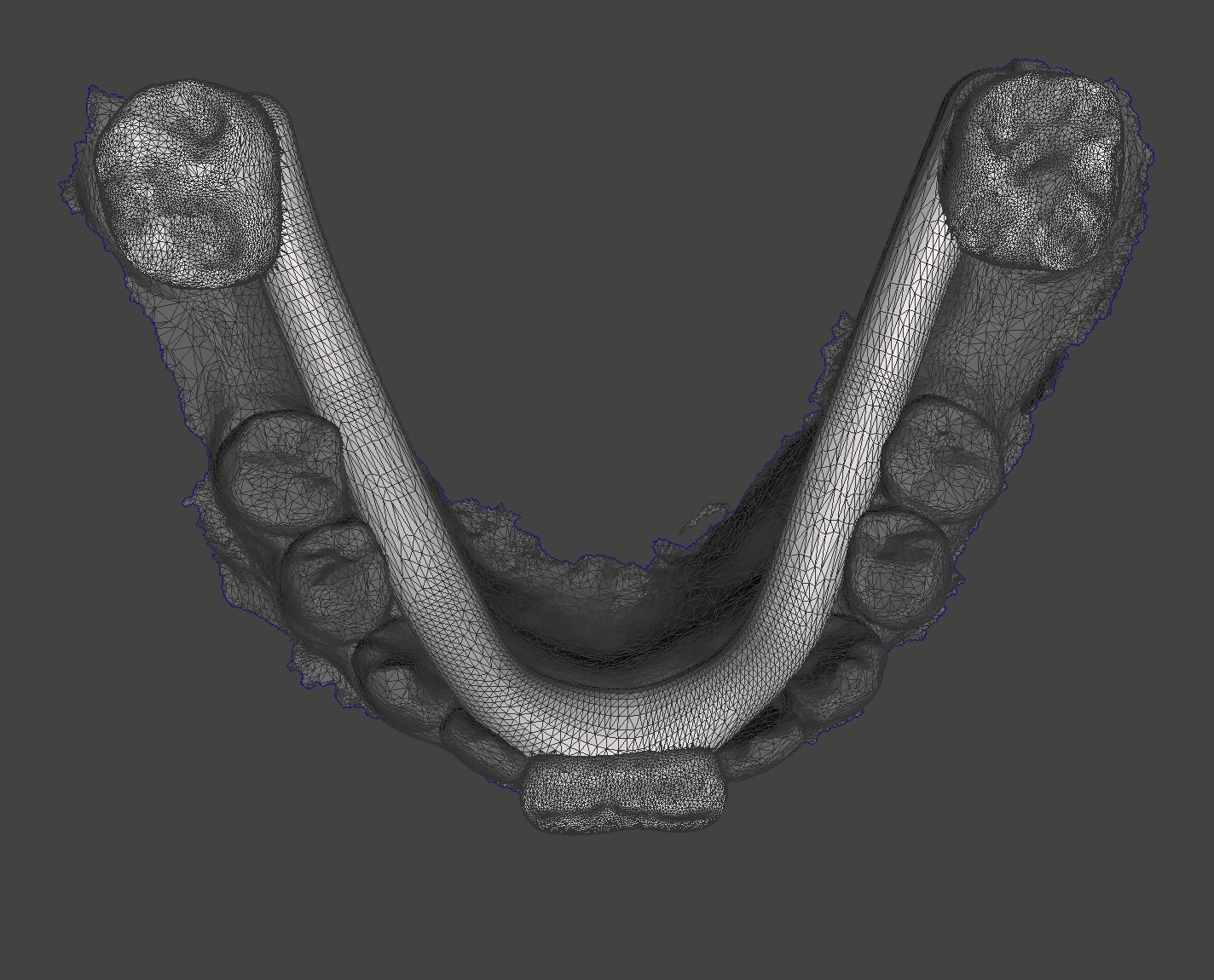 3D printed localizator designed to carry the proposed mandibular position