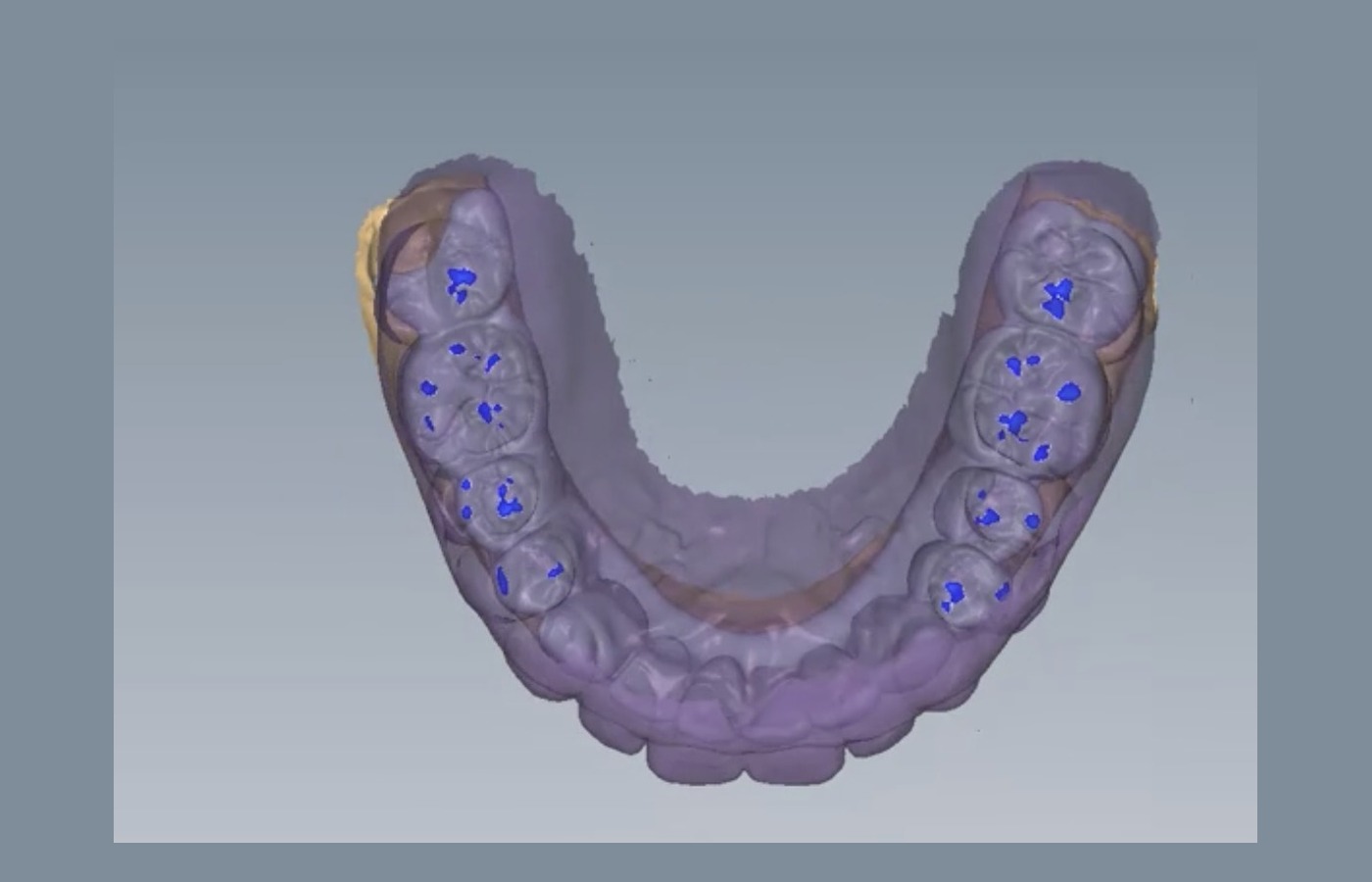 CAD visualization of planned MIP static occlusal contacts