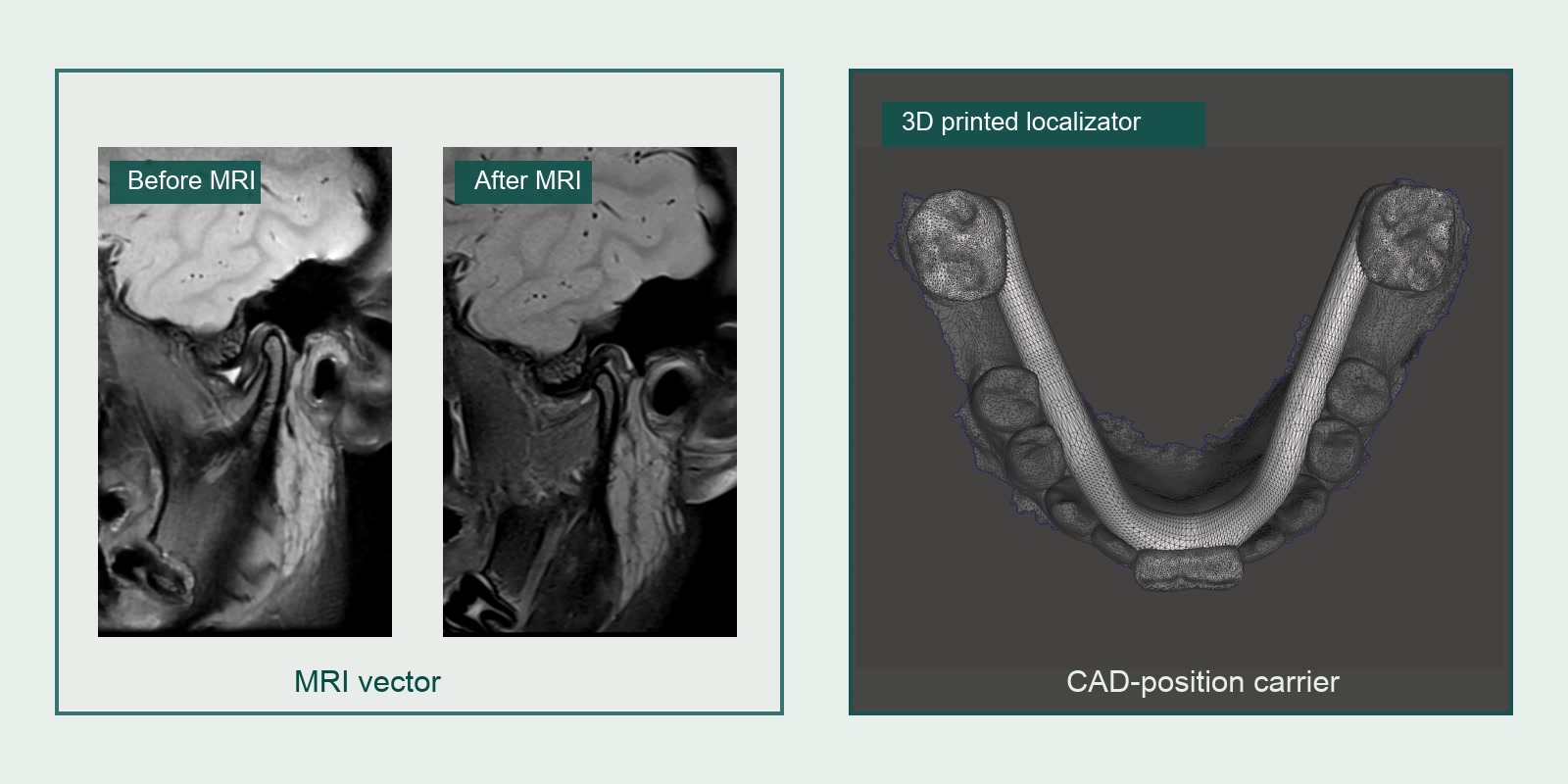 Anonymized AxisGuide MRI comparison and localizator planning reference