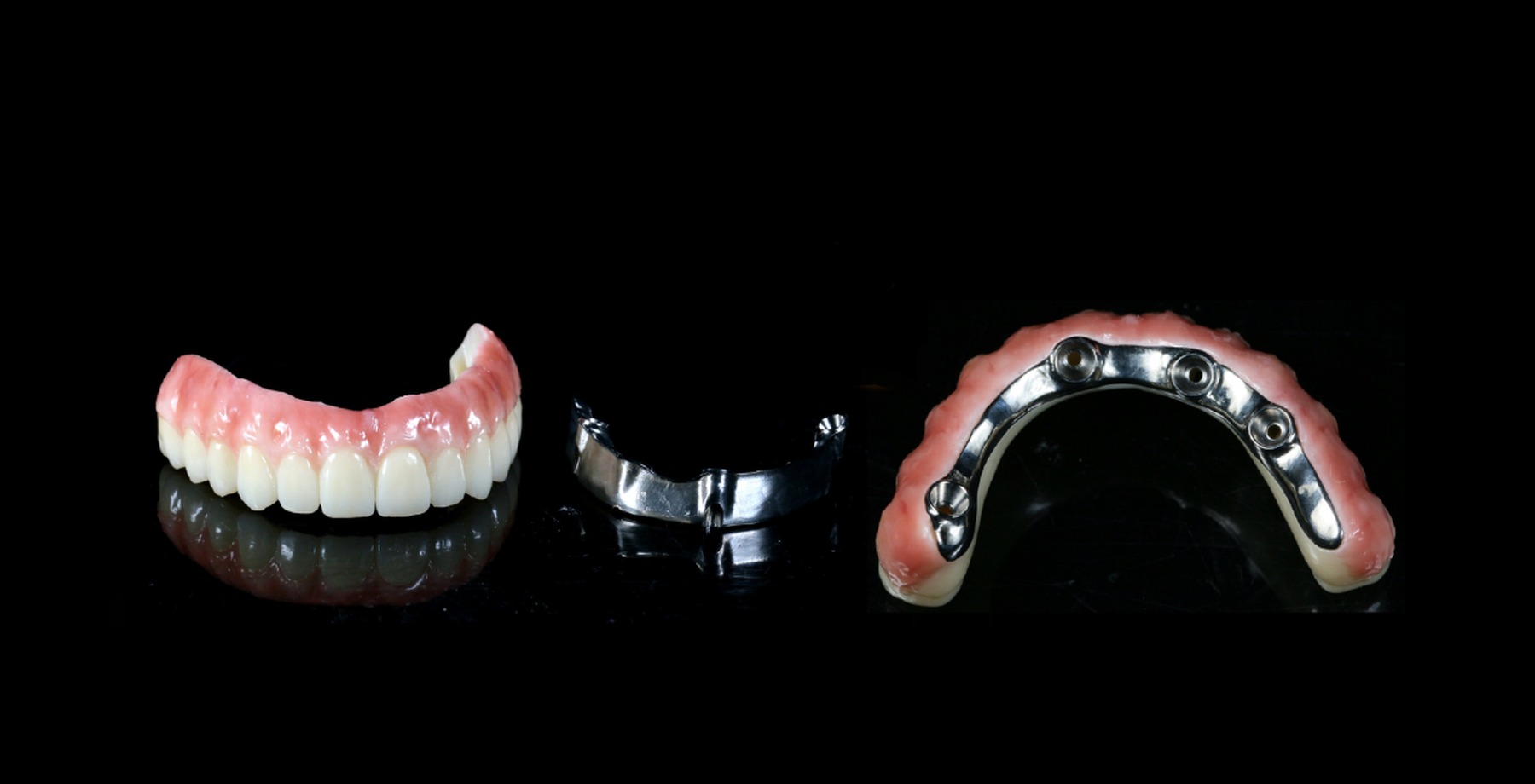 Full-arch implant prosthesis with metal framework and final prosthesis design