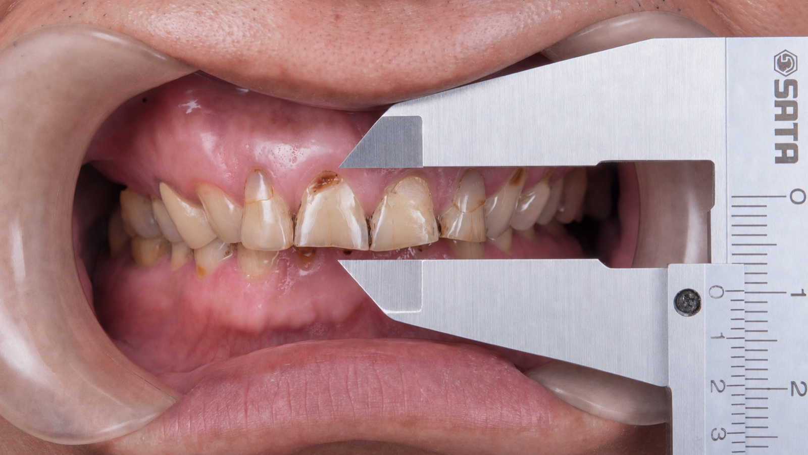 Initial worn dentition and reduced vertical dimension reference