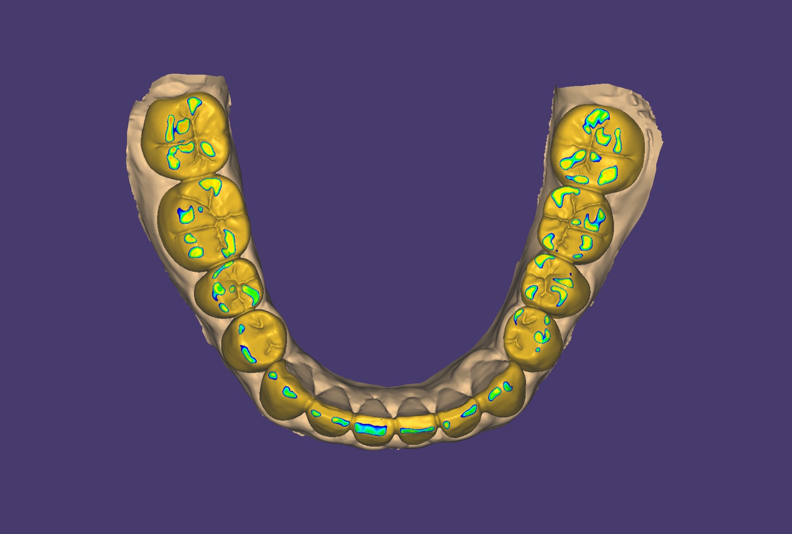 Digital full-mouth occlusal contact planning reference