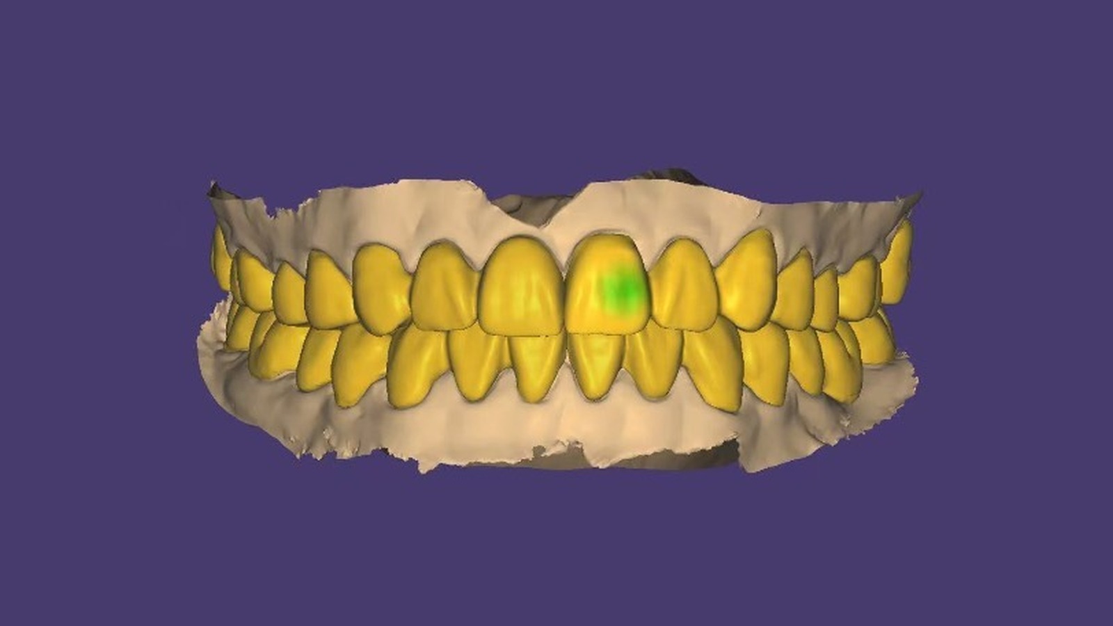 Natural dentition full-mouth occlusal rehabilitation CAD planning