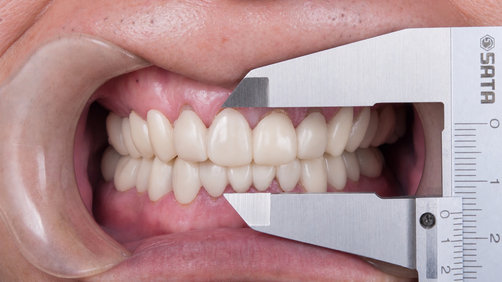 Provisional or final restorative verification after full-mouth occlusal planning