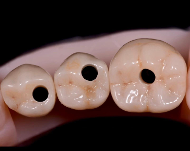 Implant crown restorative CAD output on model