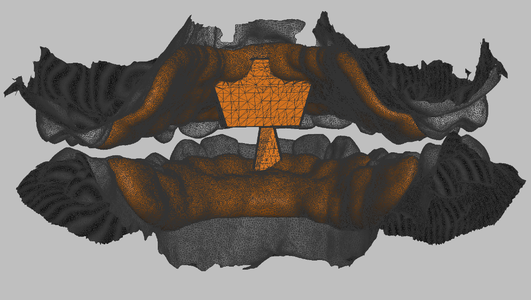 Digital deprogrammer and occlusal appliance CAD